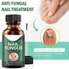 Anti Fungal Nail Treatment Nail Finger Toe Fungus Onychomycosis Remover